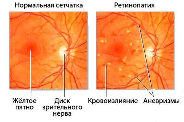 сетчатка при ретинопатии